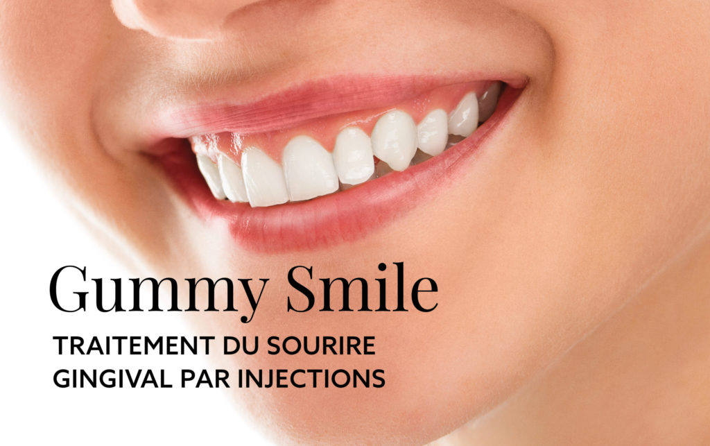 GUMMY SMILE traitement du sourire gingival par injections